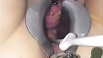 Cervix extreme gyno play