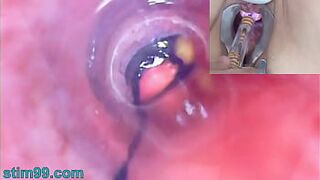 Older Woman Peehole Endoscope Web-Cam in Bladder with Balls