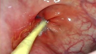 EXTREME ANAL POINT OF VIEW. WEB CAMERA INSIDE HER ASS-HOLE AS I POUND HER WITH MY HUGE ROD AND SPERM DEEP INSIDE