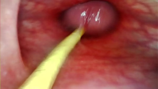 EXTREME ANAL POINT OF VIEW. ONLINE CAMERA INSIDE HER ANUS AS I POUND HER WITH MY HUGE WANG AND SPUNK DEEP INSIDE